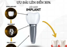 Trồng Răng Implant Chuẩn Quốc Tế 100% Chính Hãng