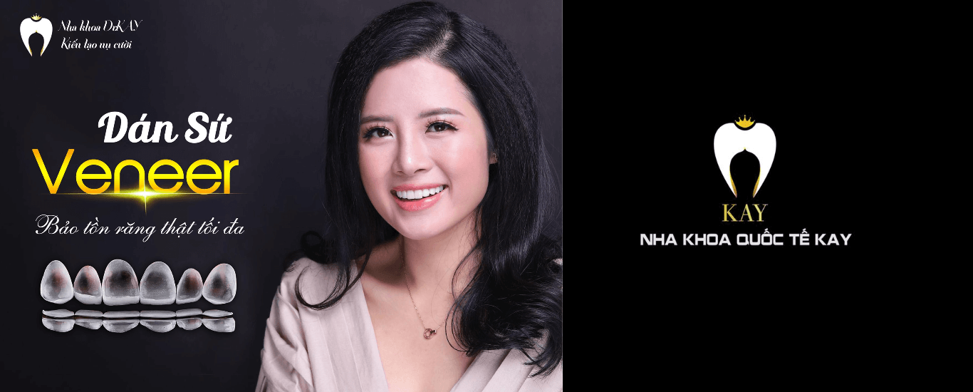 Khuyến Mãi Dán Sứ Veneer